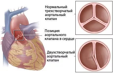 Сужение сосудов аорты лечение симптомы причины