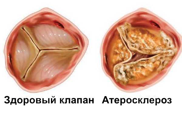 Как лечить аортальный клапан без операций